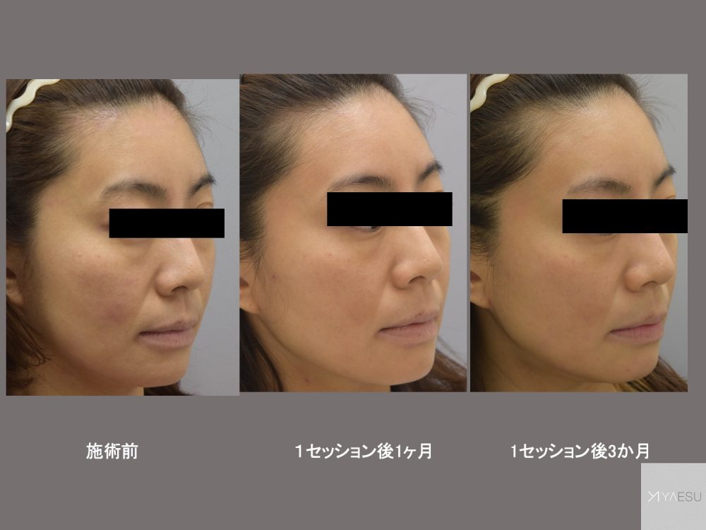 スネコス（SUNEKOS） | 八重洲形成外科・美容皮膚科