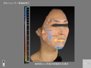 ボルニューマ―変化ベクトラ解析