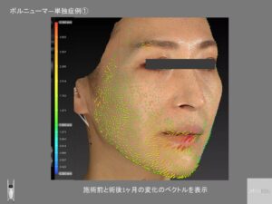 ボルニューマ―変化のベクトル