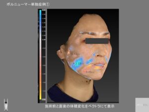 ボルニューマ―直後の変化ベクトラ解析