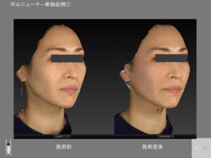 ボルニューマ―直後の変化
