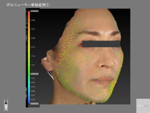 ボルニューマ―直後の変化ベクトル