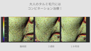 大人のたるみ毛穴にはコンビネーション治療