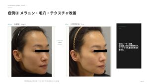 ラビアンマイルドモードの変化