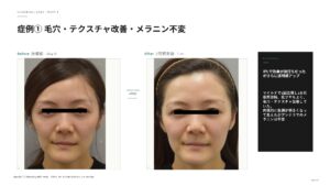 ラビアンマイルドモードの変化