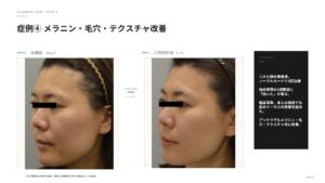 ラビアンノーマルモードの変化