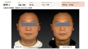 ニュービジュモニターあご下